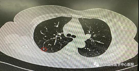 胸科醫(yī)院完成西北地區(qū)首例“Lung Pro全肺診療導航系統聯合單孔胸腔鏡下右肺上葉后段切除術”