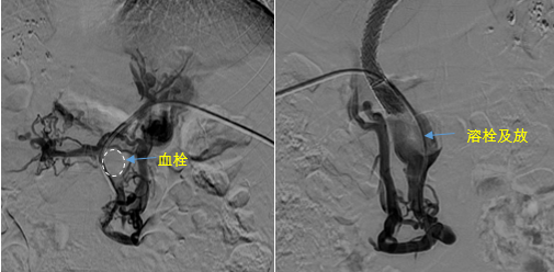 血栓攔路，如何破局——罕見巨大門靜脈血栓TIPS手術(shù)實錄