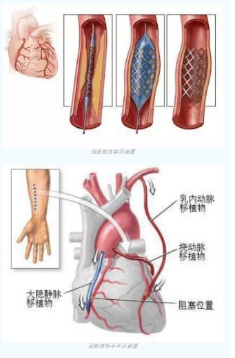 魚與熊掌不可兼得？冠脈雜交手術(shù)一站式解決問題