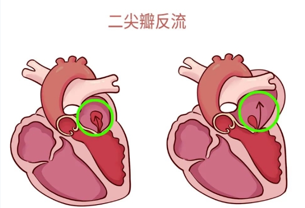 體檢報(bào)告里的心臟瓣膜反流，你讀懂了嗎？