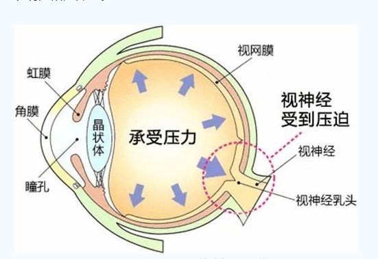 世界青光眼日｜共管慢病青光眼 留得光明恒久遠